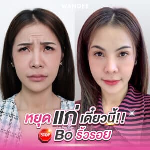 รีวิวโบท็อกซ์