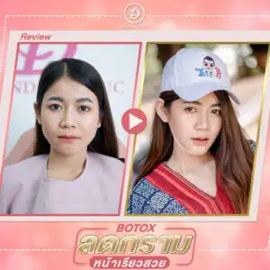 รีวิวโบท็อกซ์