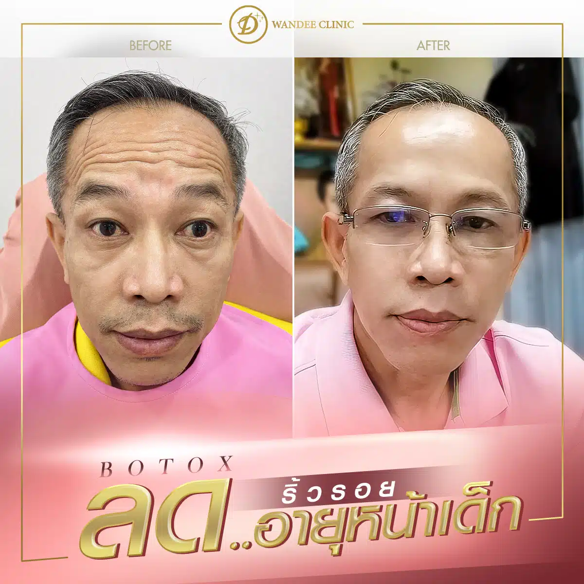 รีวิวโบท็อกซ์ ลดริ้วรอย หน้าเด็ก