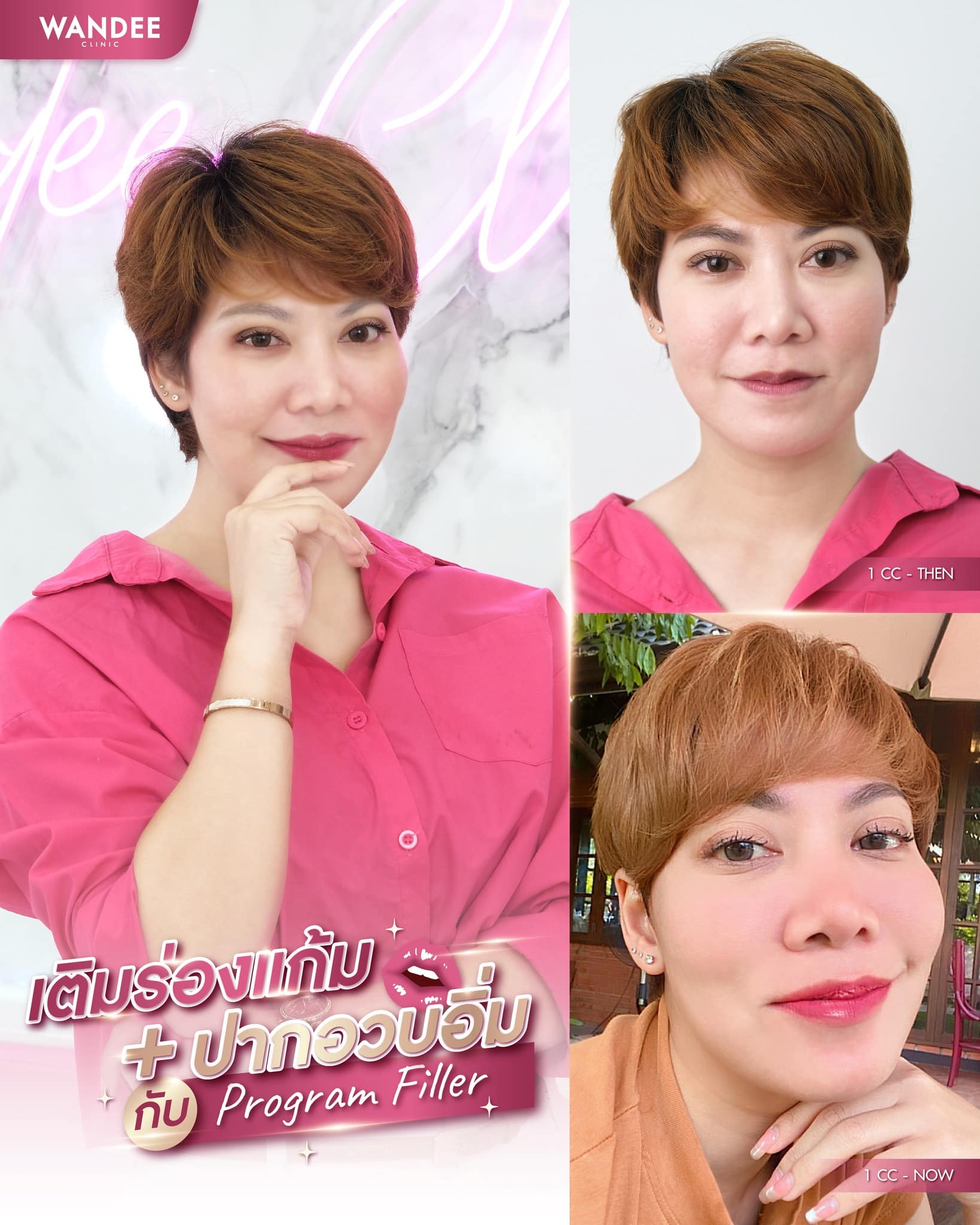 Filler เติมแก้ม เติมปาก