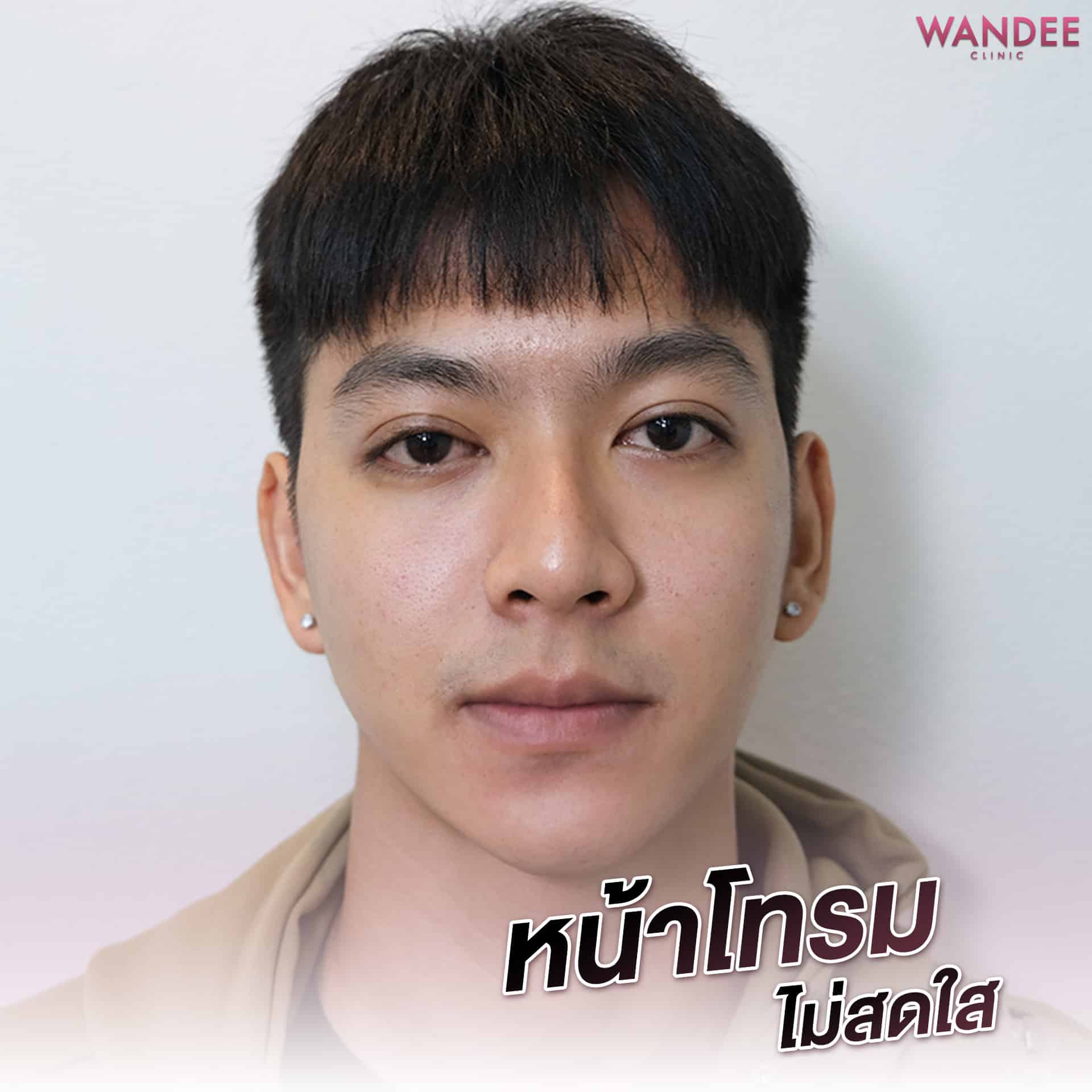 รีวิวเมโสหน้าใส คุณบอส