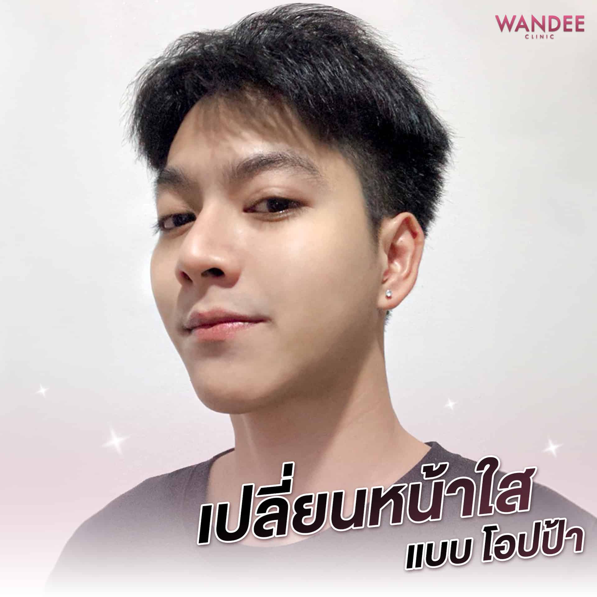 รีวิวเมโสหน้าใส คุณบอส