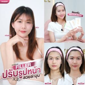ปรับรูปหน้าเป๊ะ ฟิลเลอร์ทั่วหน้า ฟิลเลอร์วันดี คลินิก