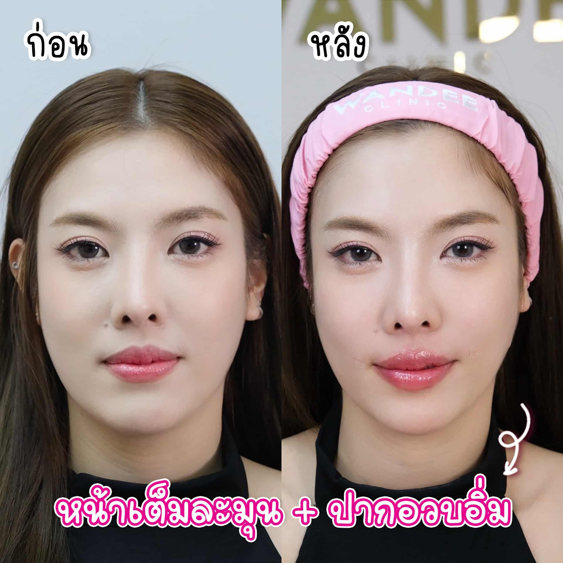 หน้าเต็มสวยละมุน กับฟิลเลอร์ที่วันดี คลินิก