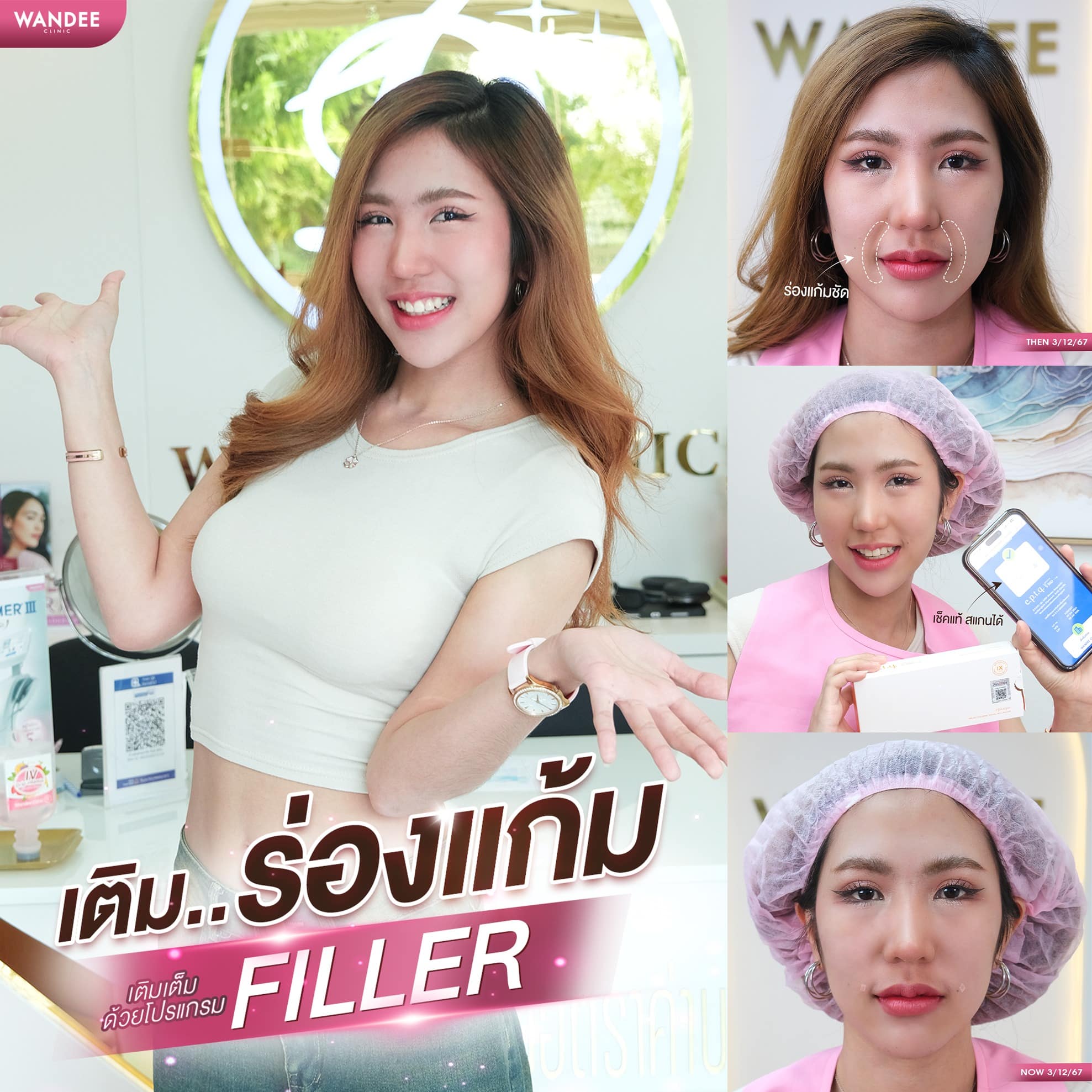 ฟิลเลอร์ร่องแก้ม วันดี คลินิก