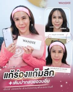 ฟิลเลอร์ร่องเเก้ม