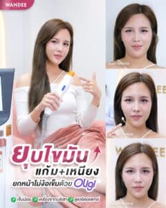 ยกกระชับแบบไม่ง้อเข็ม