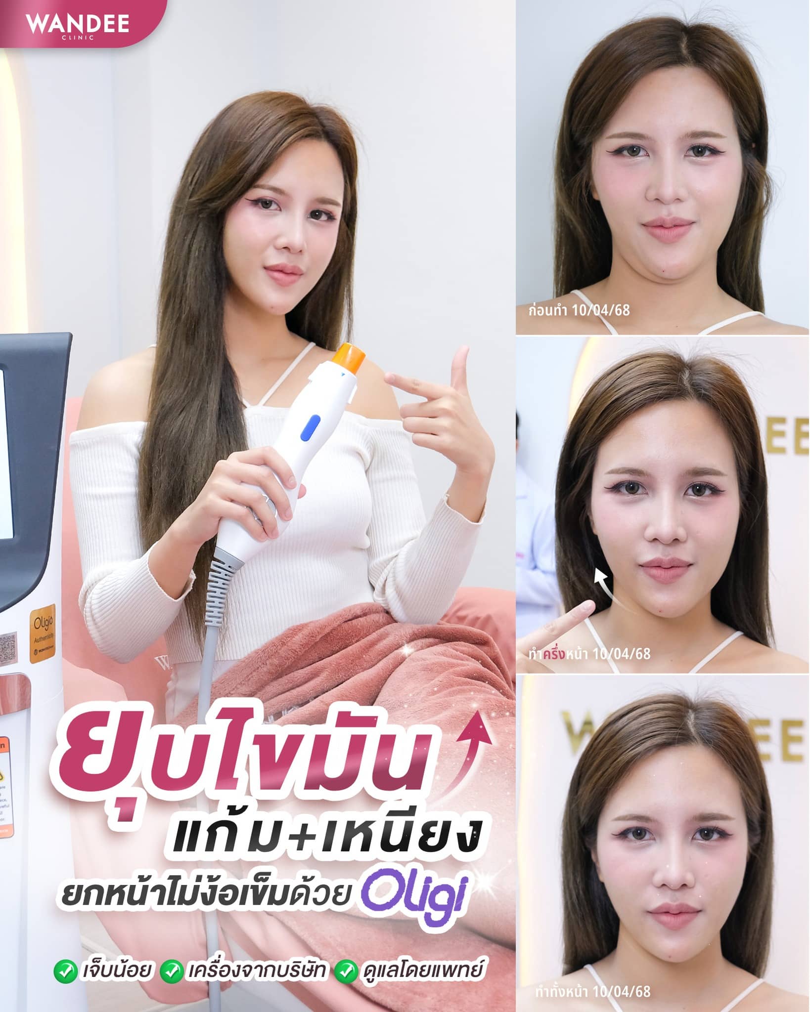 ยกกระชับแบบไม่ง้อเข็ม