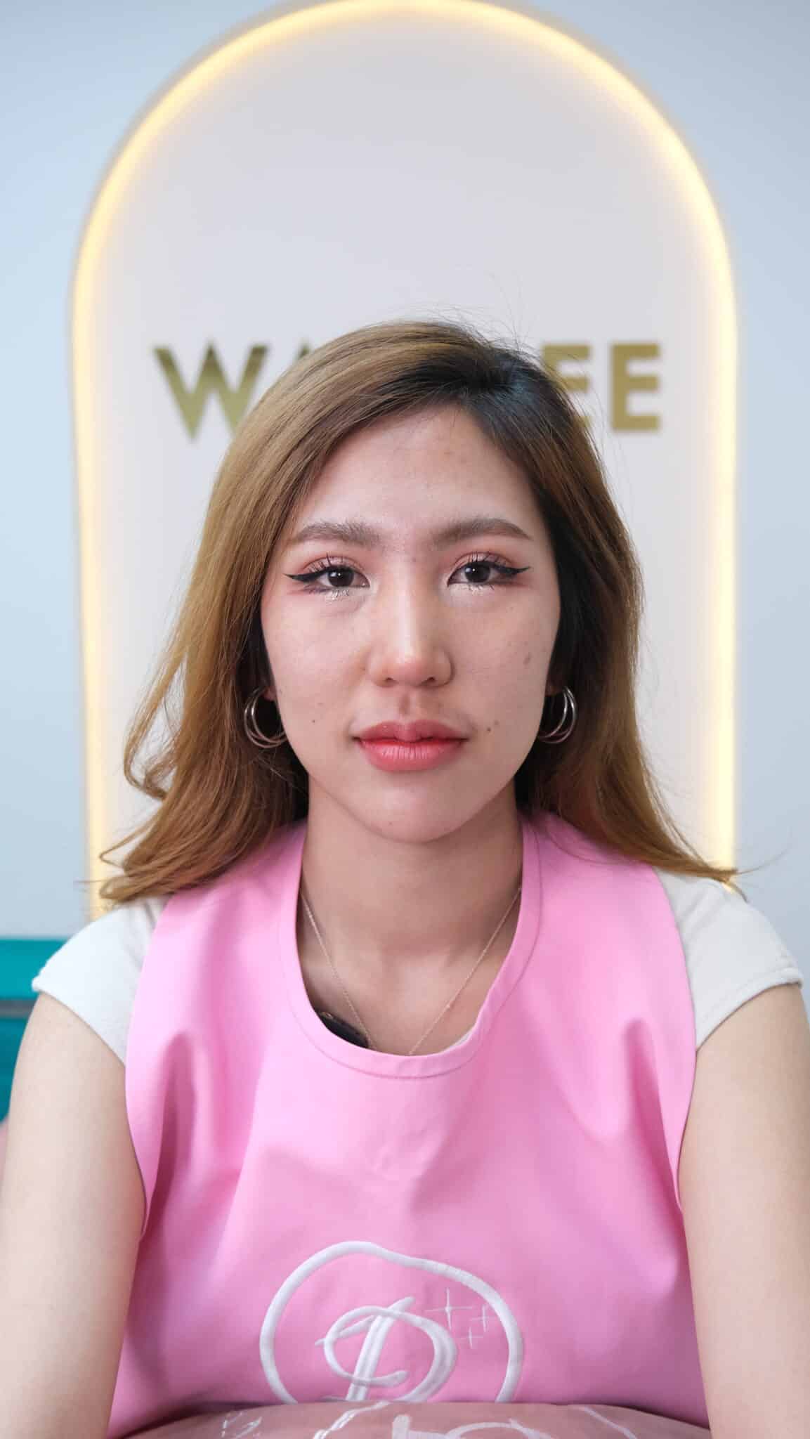 ฟิลเลอร์ เจลลี่