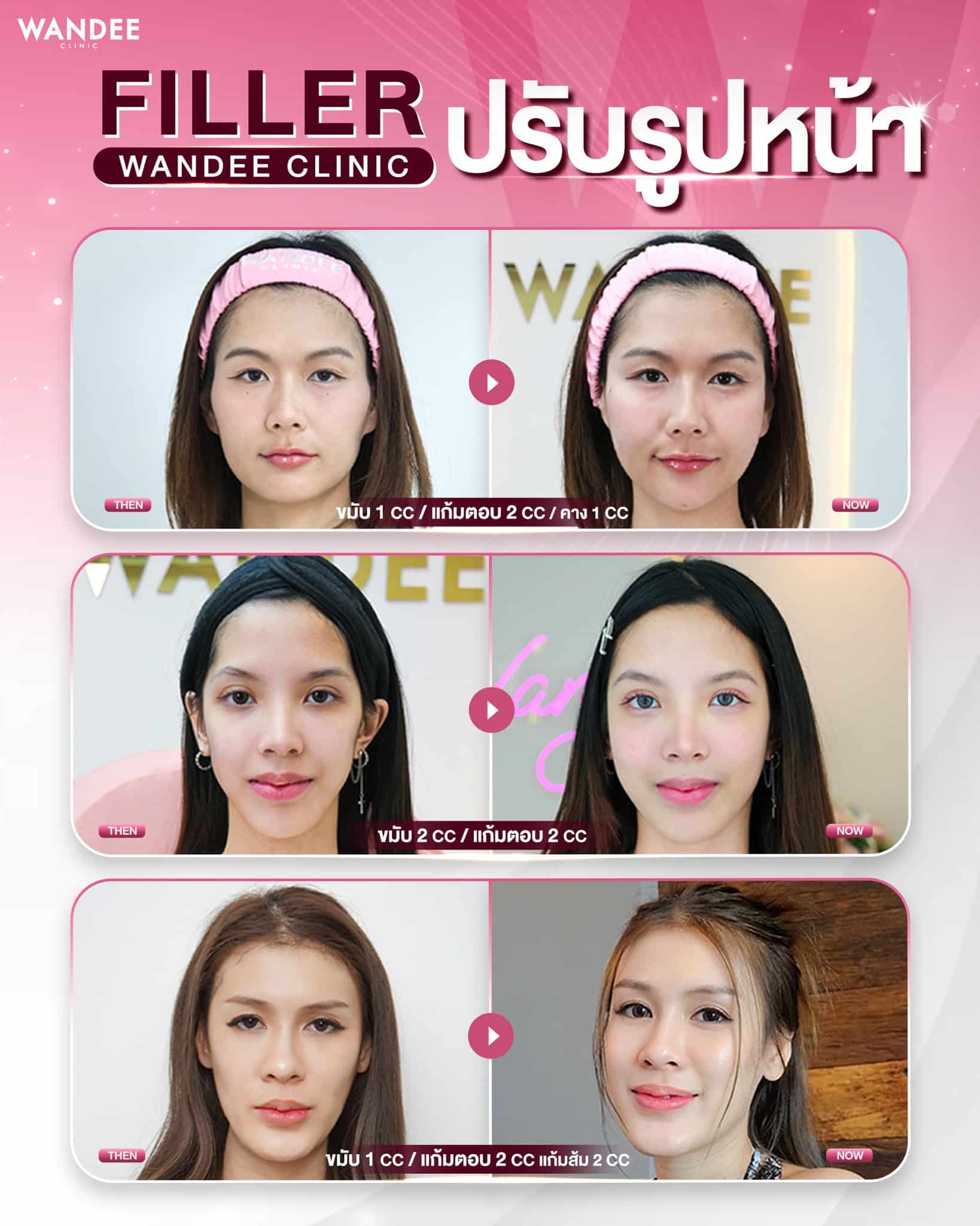 ปรับสวย ปรับรูปหน้า ด้วยฉีด Filler จาก Wandee Clinic