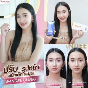 ฟิลเลอร์หน้าเด็ก