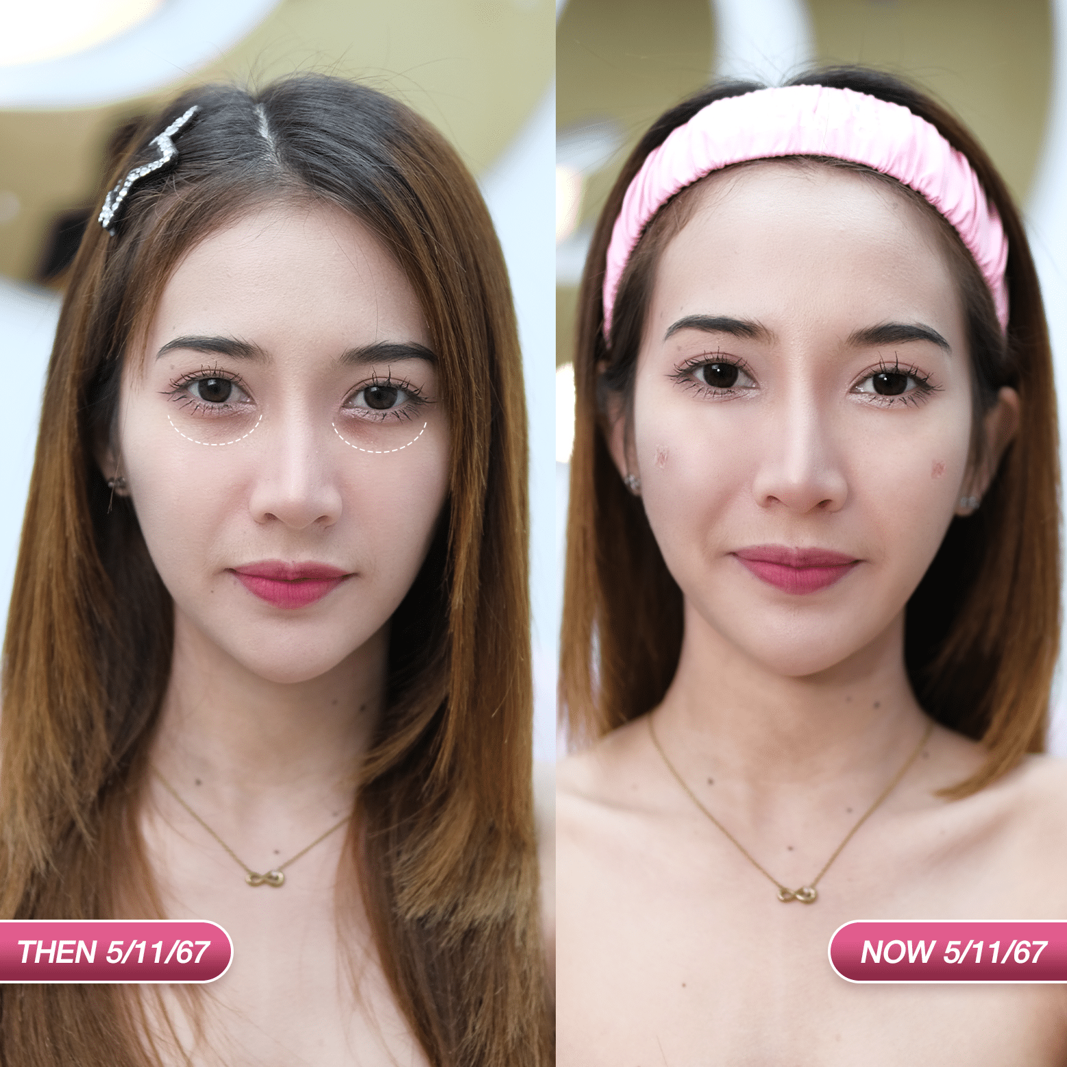 ฟิลเลอร์ใต้ตา ภัส