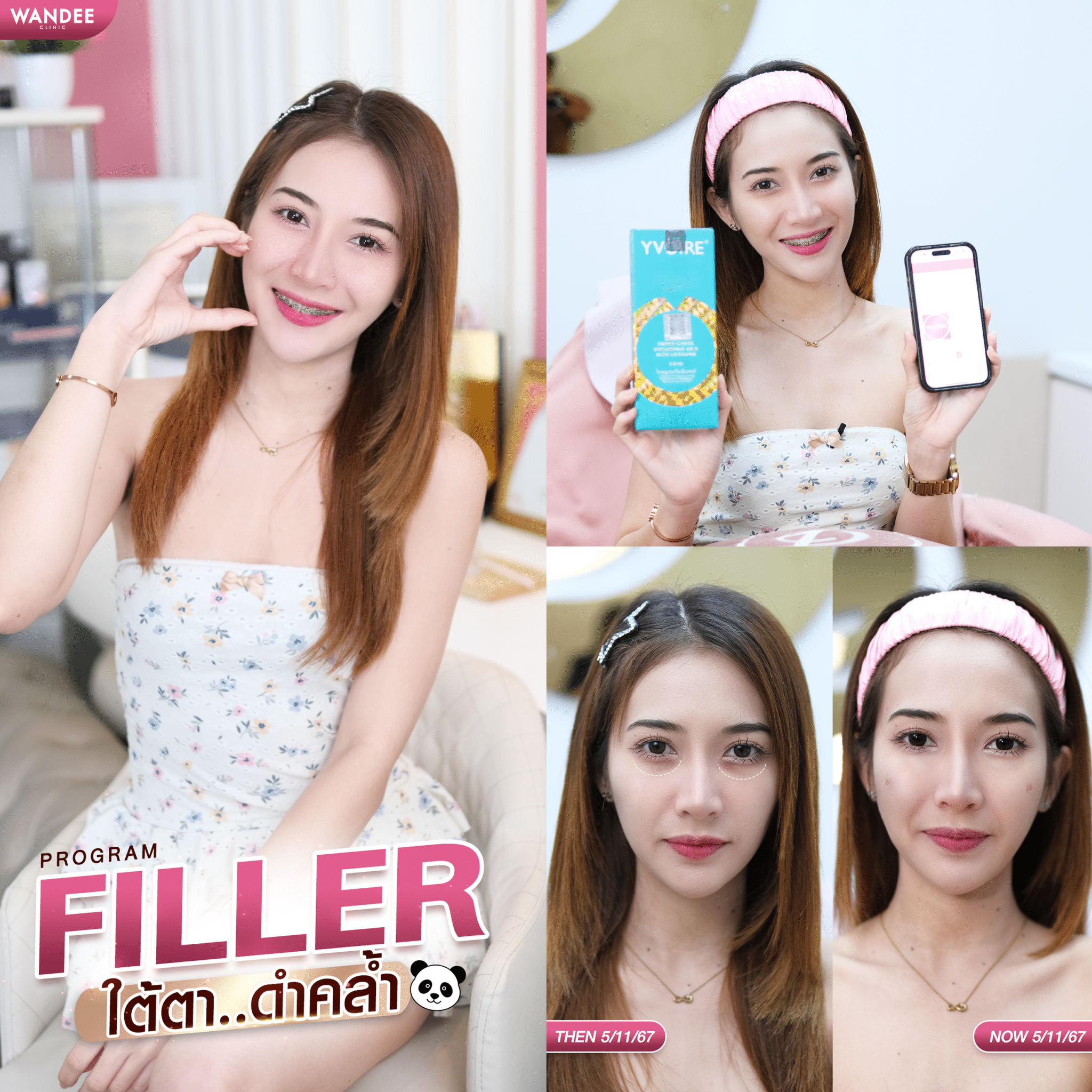 ฟิลเลอร์ใต้ตา ภัส