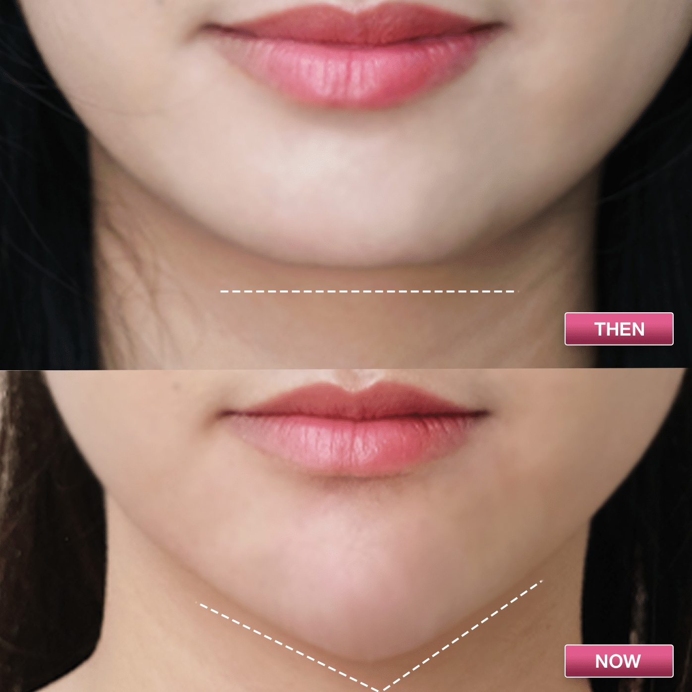 ฟิลเลอร์คาง โดนัท