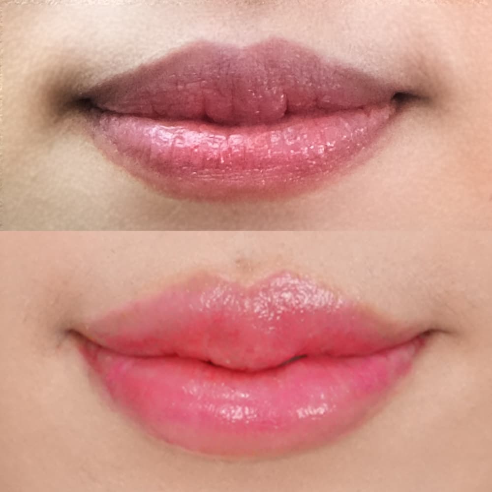 ฟิลเลอร์ปาก มุ้งมิ้ง