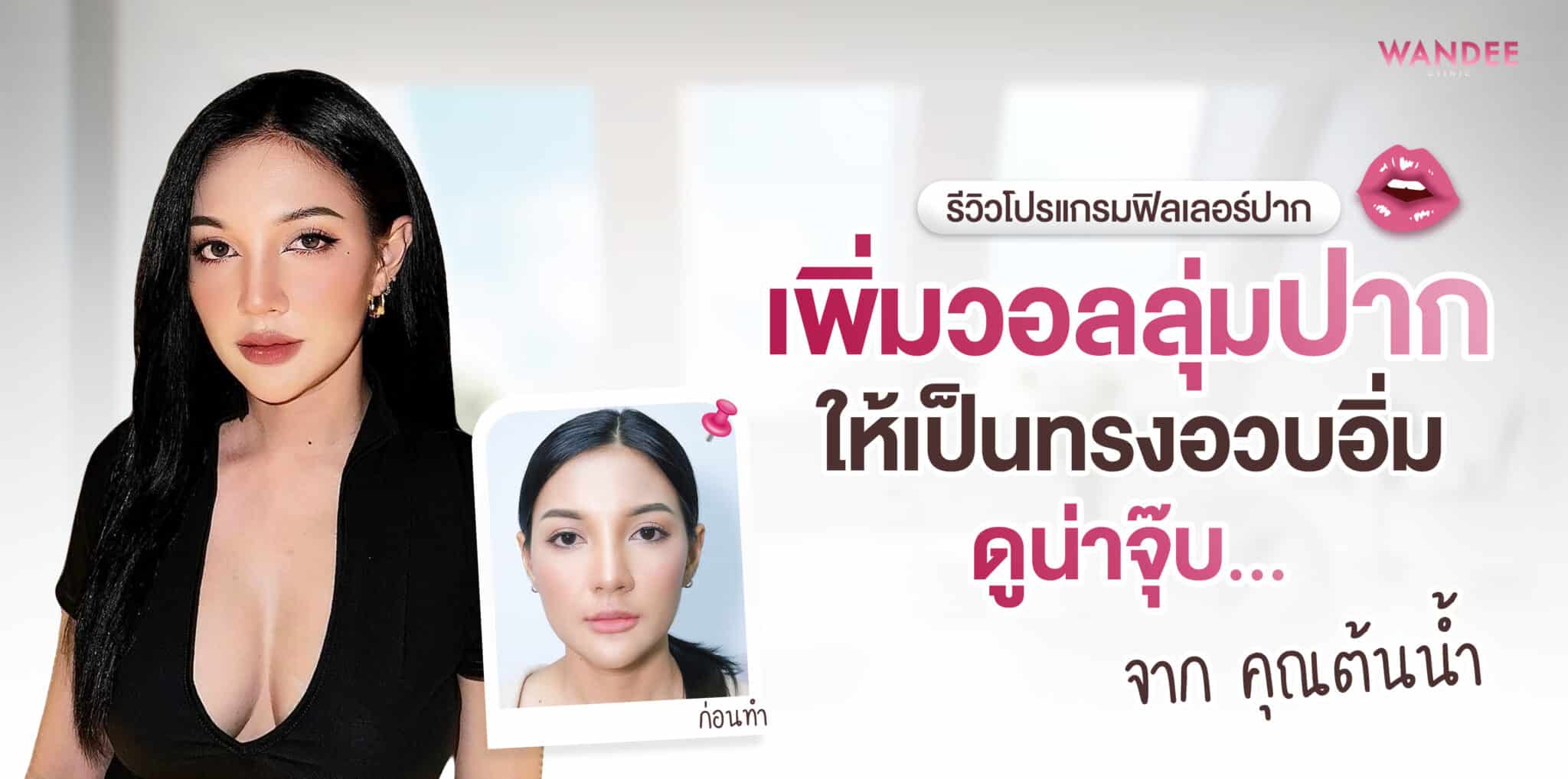 ฟิลเลอร์ปาก ต้นน้ำ