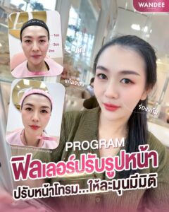 ฟิลเลอร์กรอบหน้า