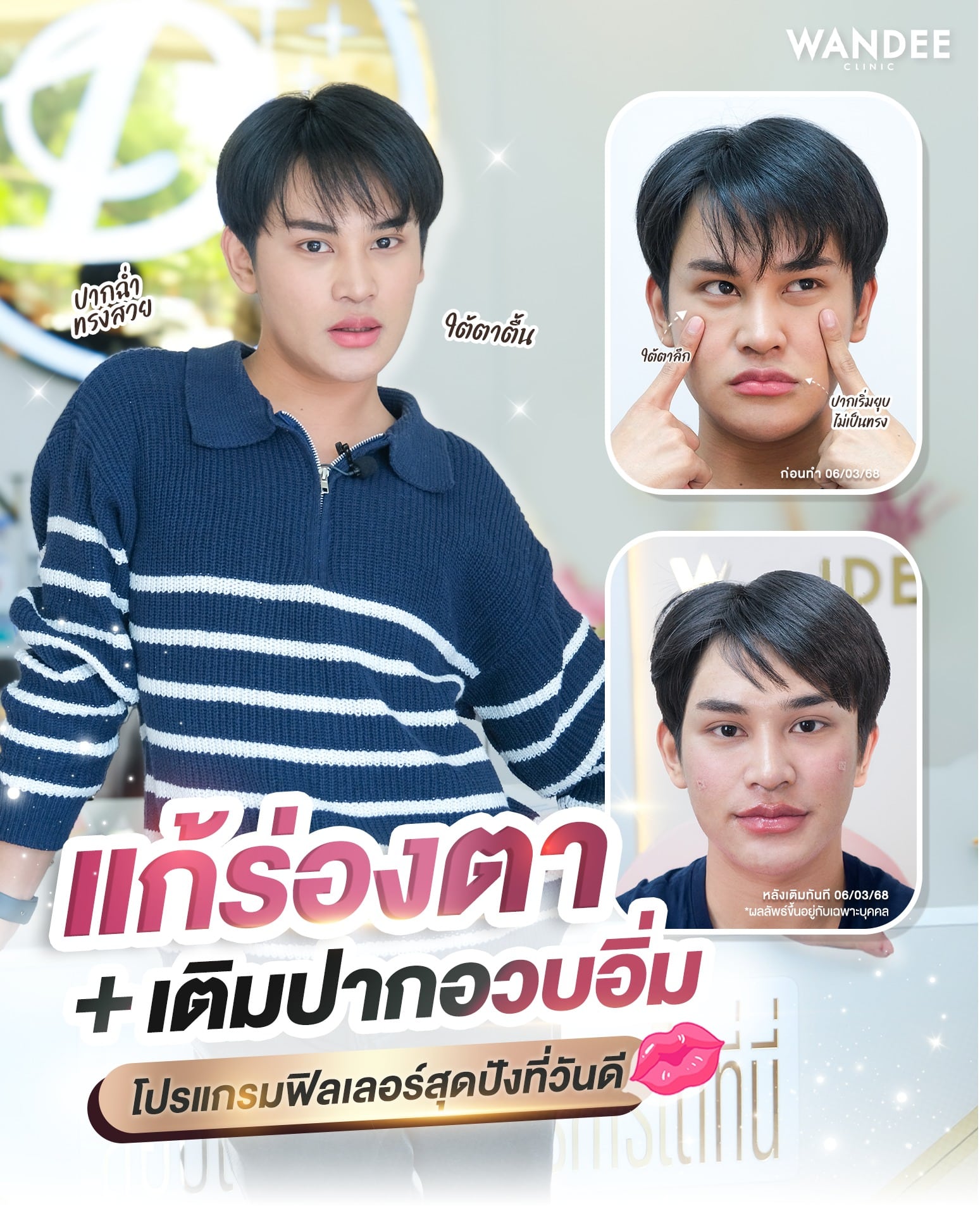 ฟิลเลอร์ปาก+ใต้ตา