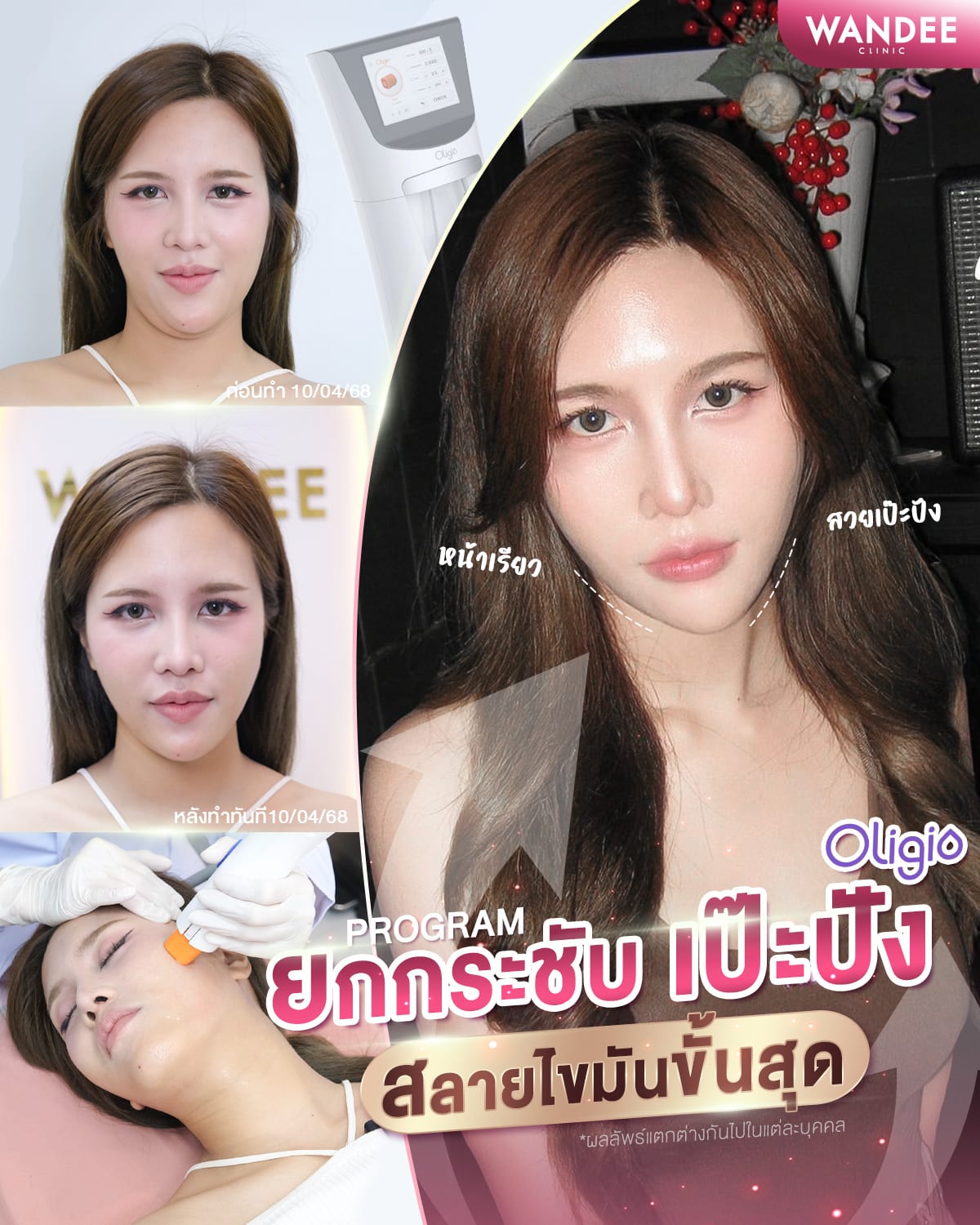 สลายไขมันขั้นสุด