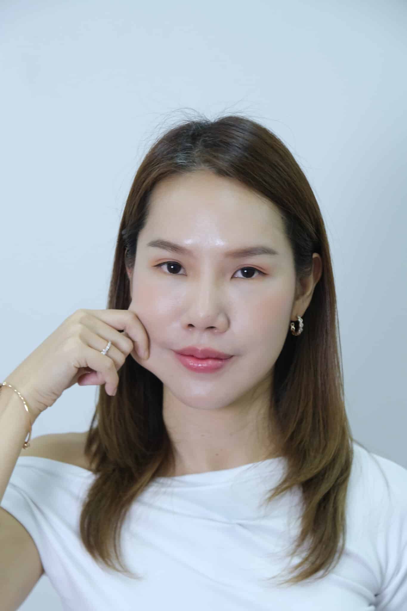 รีวิวโปรแกรม-Sculptra-มาย