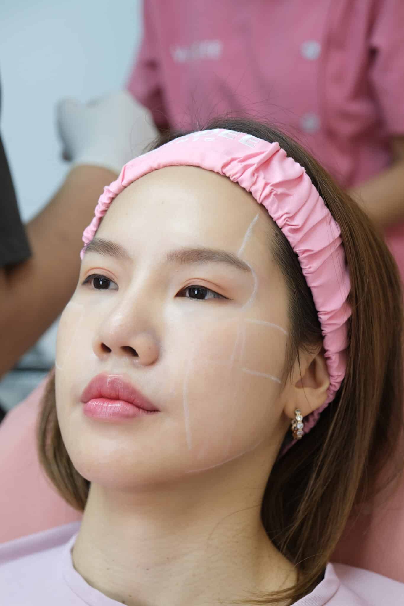 รีวิวโปรแกรม-Sculptra-มาย