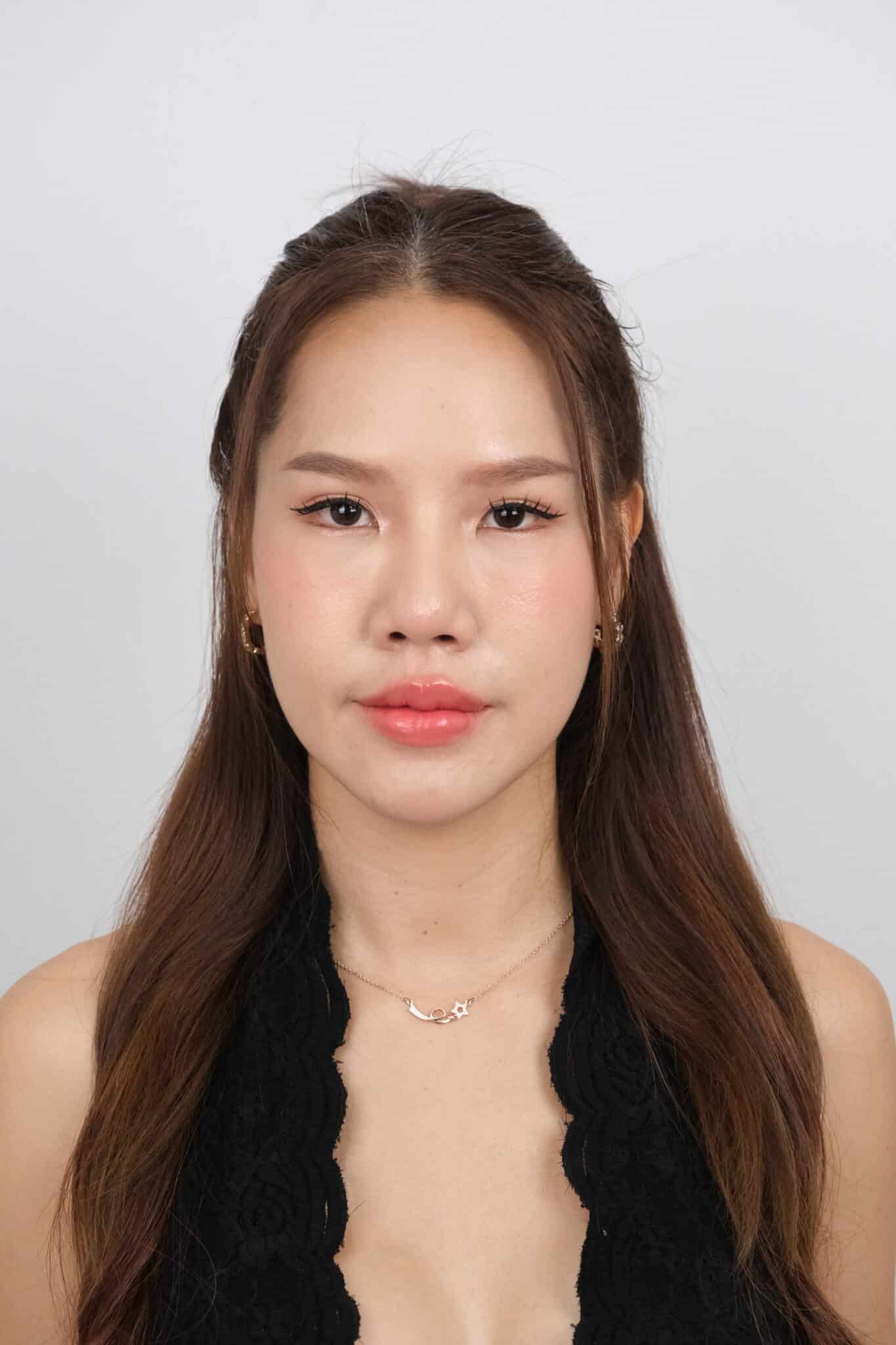 รีวิวโปรแกรม-Sculptra-มาย