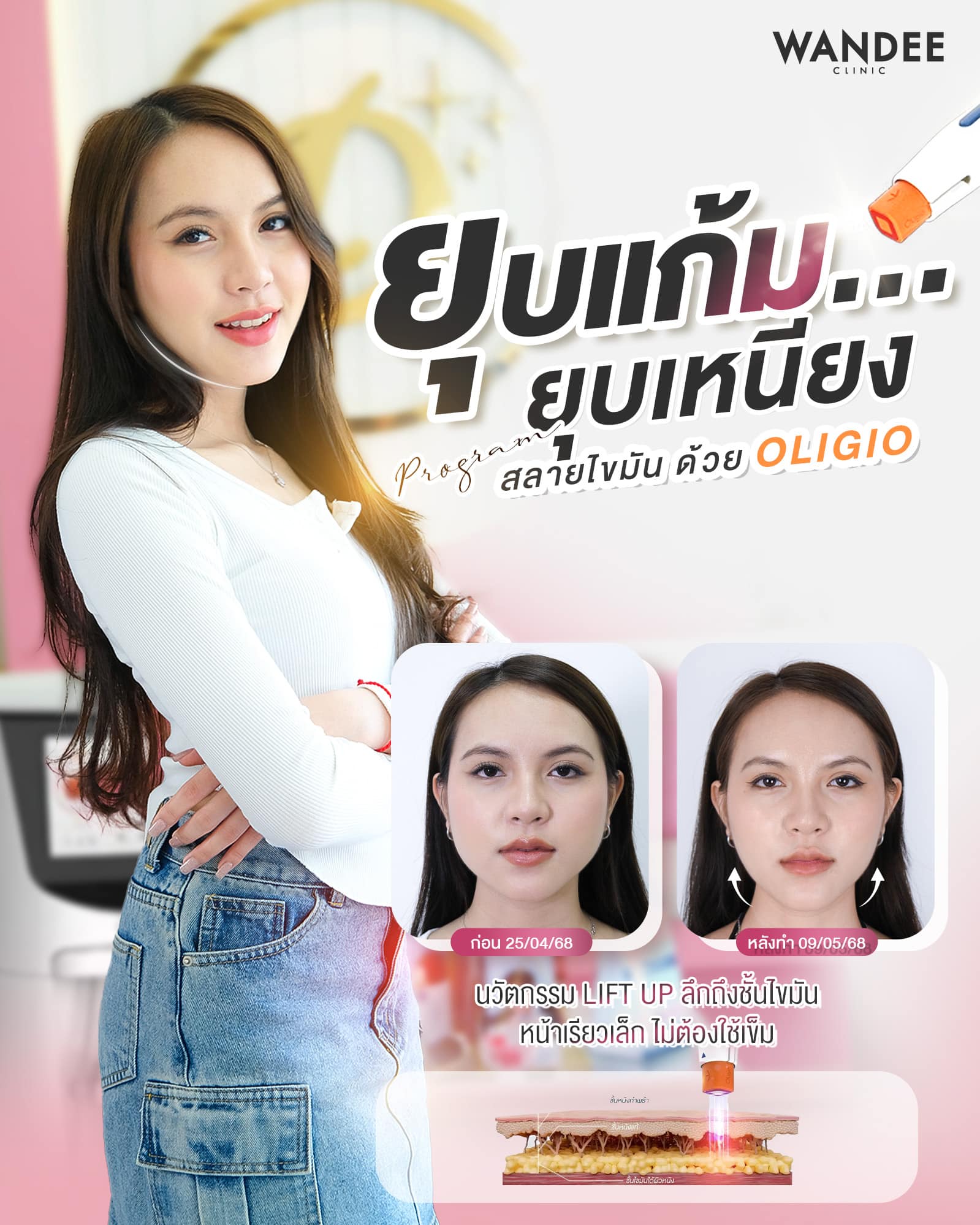 ยุบแก้มยุบเหนียง