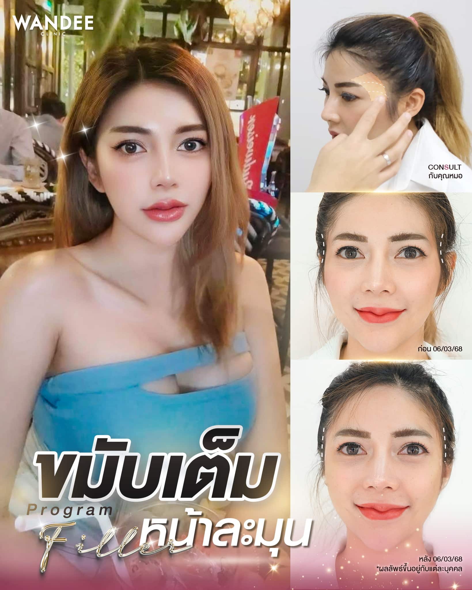 ฟิลเลอร์ขมับเต็มหน้าละมุน