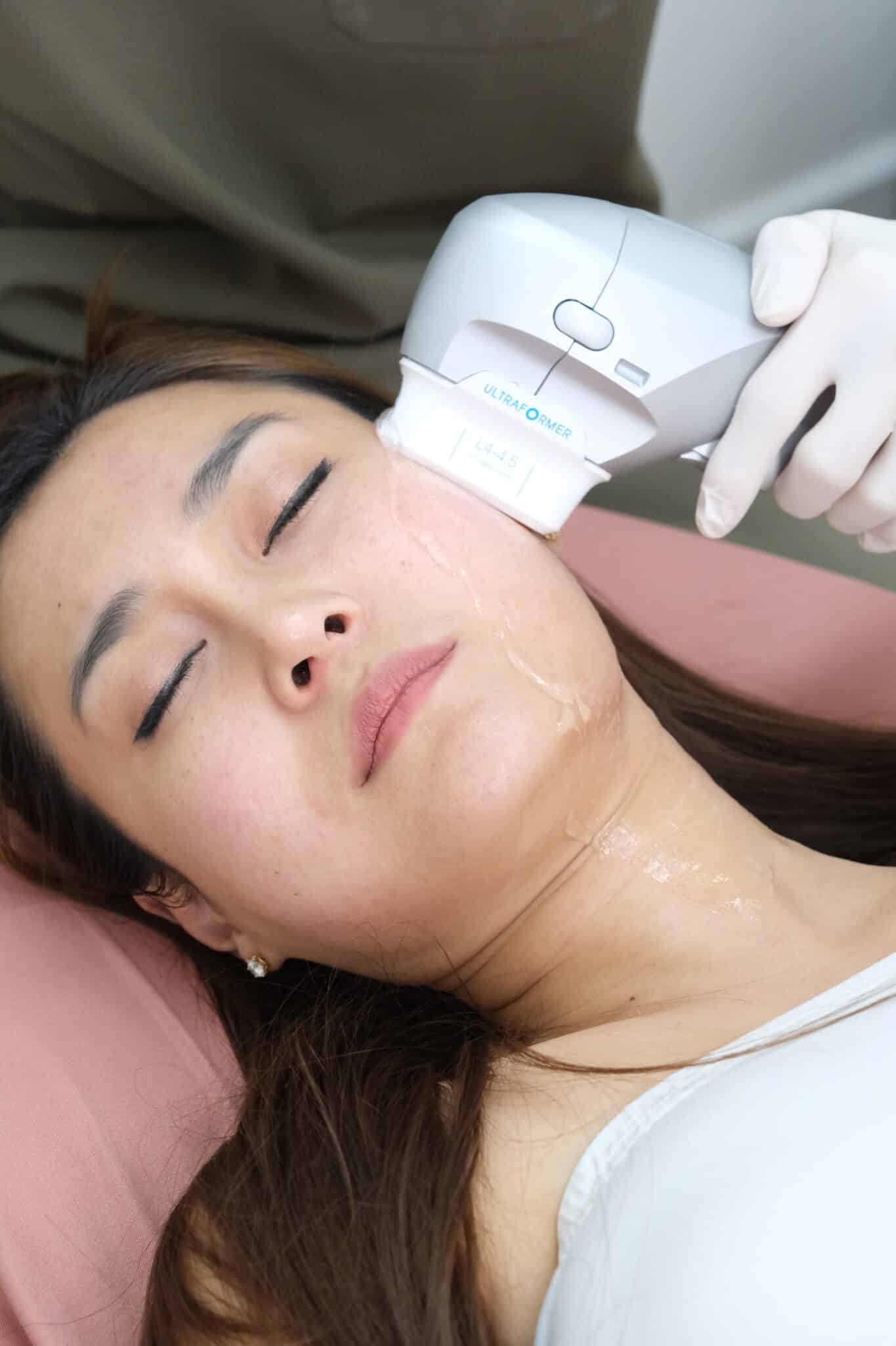 ultraformer เมย์