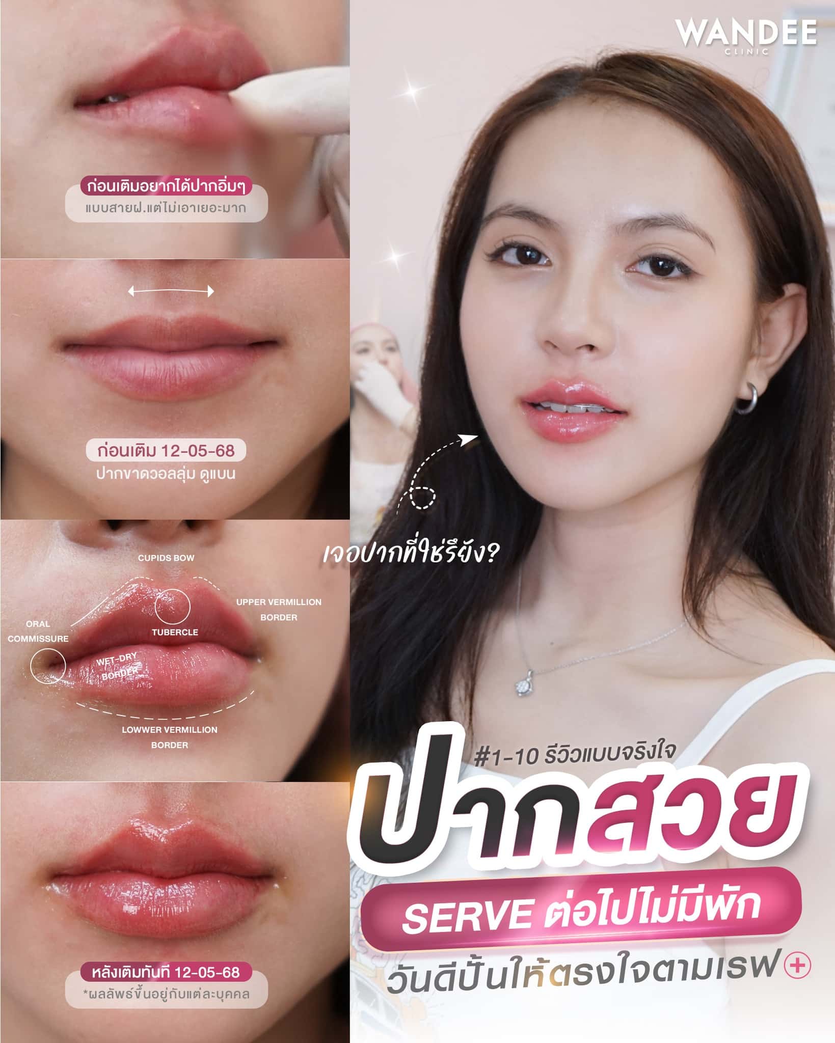 ฟิลเลอร์ปาก วันดี คลินิก