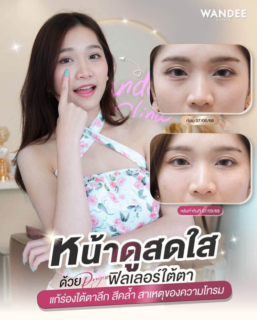 𝗣𝗿𝗼𝗴𝗿𝗮𝗺 𝗙𝗶𝗹𝗹𝗲𝗿 ใต้ตา