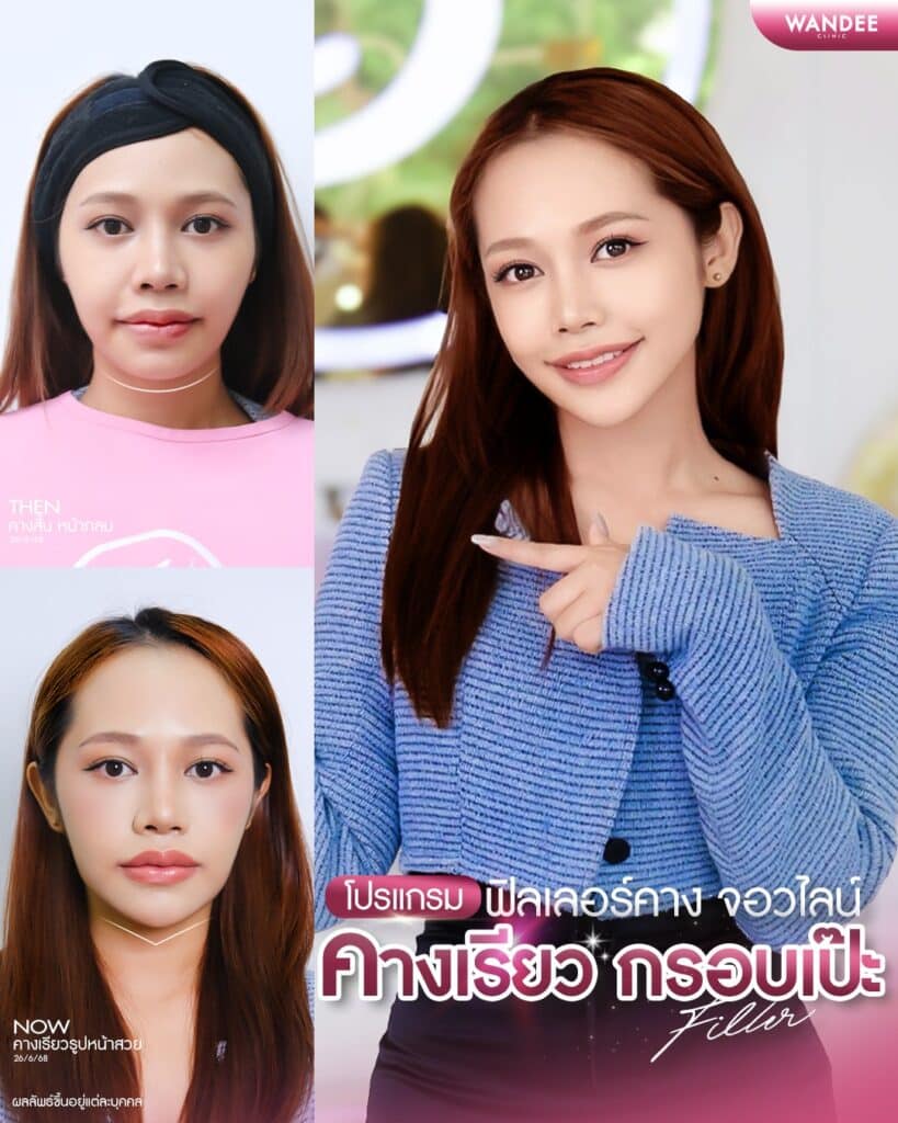 ฟิลเลอร์ กรอบหน้า