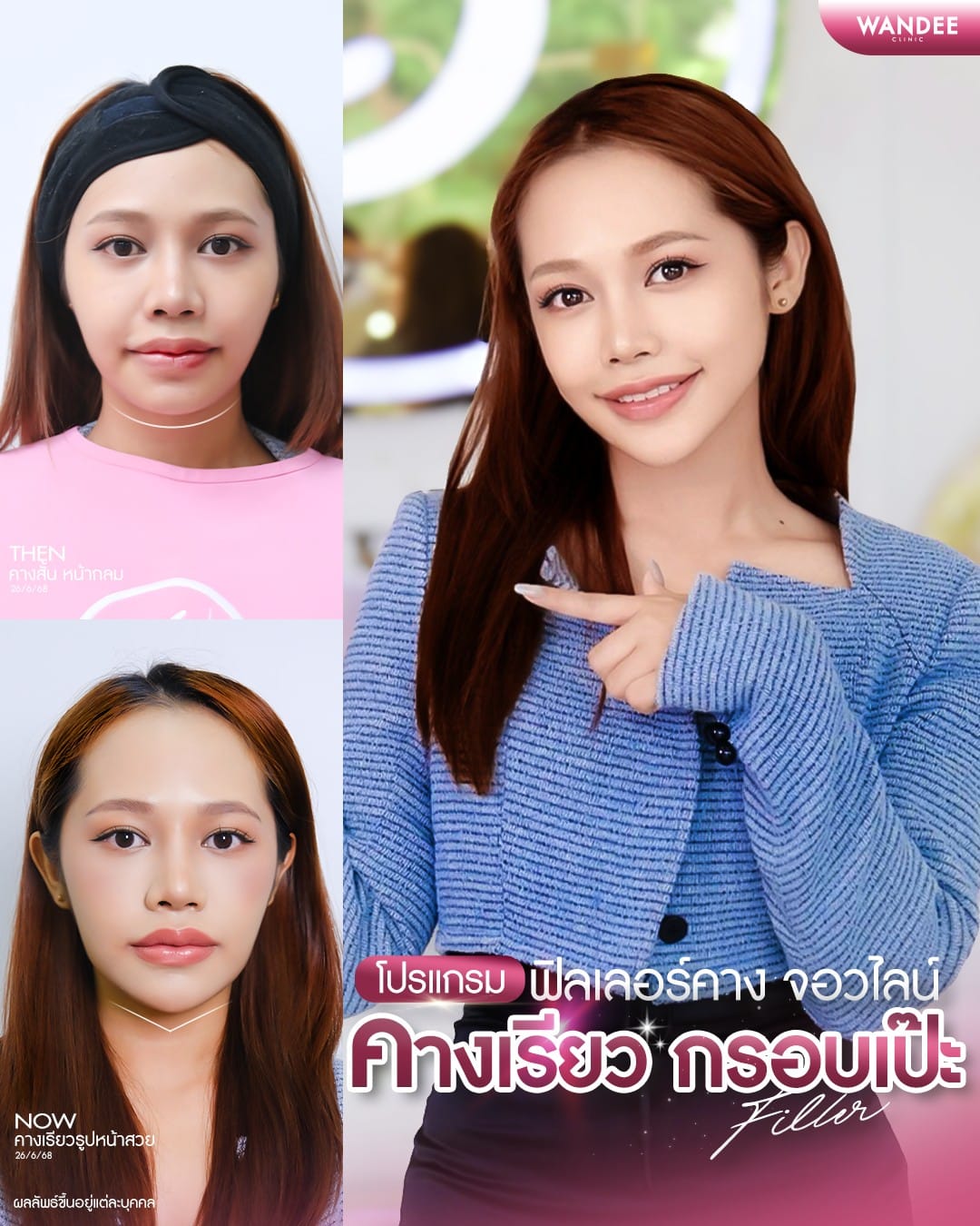 ฟิลเลอร์ กรอบหน้า