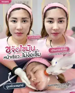 ขจัดไขมัน อัปหน้าเรียว