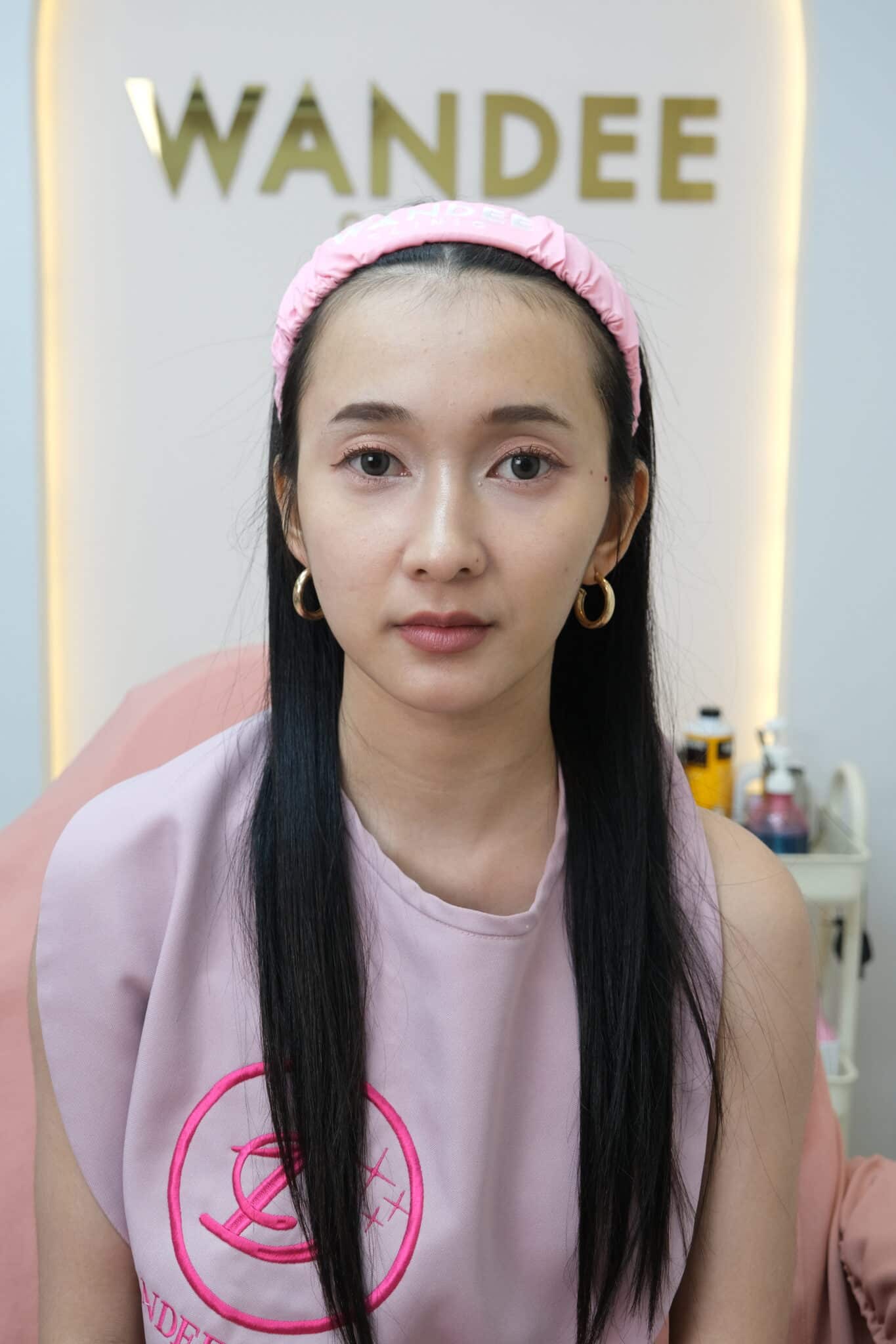 น้องแมงปอ หลังเติม 1ข้าง