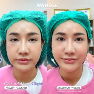 ยุบไขมัน หน้าเรียว กรอบชัด