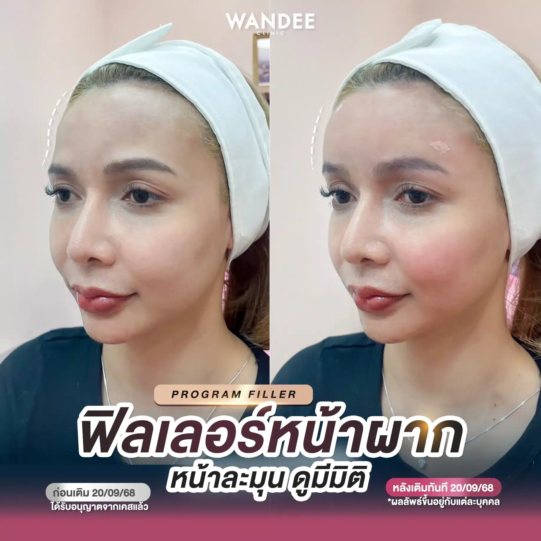 ฟิลเลอร์หน้าผาก