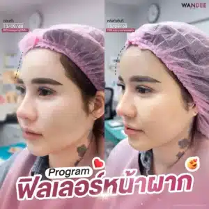 หน้าผากละมุนสวย