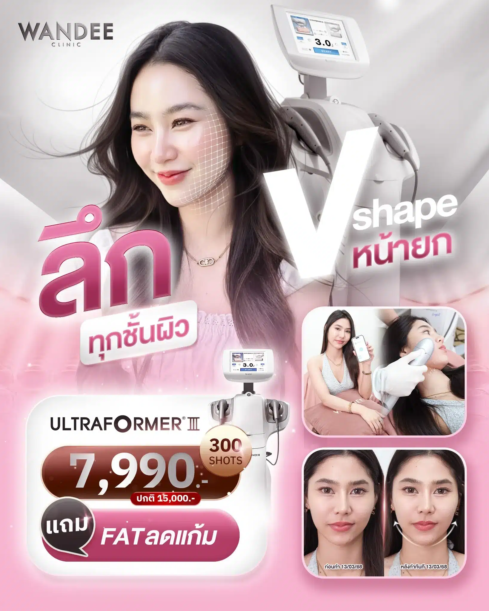 ลึกทุกชั้น หน้ายก 𝗩-𝗦𝗵𝗮𝗽𝗲 😘 ด้วยโปรแกรม 𝗨𝗹𝘁𝗿𝗮𝗳𝗼𝗿𝗺𝗲𝗿 𝗜𝗜𝗜 💟 ยกกระชับหน้าเรียว+สลายแก้มในขั้นตอนเดียว 💕 รีบจองเลย คุ้มมาก! ⠀ ⠀ ⠀ 📢 โปร 𝗛𝗢𝗧! ห้ามพลาด 💖 โปรแกรม 𝗨𝗹𝘁𝗿𝗮𝗳𝗼𝗿𝗺𝗲𝗿 𝗜𝗜𝗜 ยกหน้าเรียว 𝟯𝟬𝟬 𝗦𝗵𝗼𝘁𝘀 เพียง 𝟳𝟵𝟵𝟬.- (ปกติ 15,000.-) แถม 𝗙𝗥𝗘𝗘 ! แฟตลดแก้ม ⠀ ⠀ ⠀ ⭐ 𝗨𝗹𝘁𝗿𝗮𝗳𝗼𝗿𝗺𝗲𝗿 𝗹𝗹𝗹 ที่ 𝗪𝗮𝗻𝗱𝗲𝗲 𝗖𝗹𝗶𝗻𝗶𝗰 ㆍ ยกกระชับลึก 𝘅𝟭𝟬 ถึงชั้น 𝗦𝗠𝗔𝗦 ผิวแน่นวีเชฟ เจ็บน้อย ㆍ กระตุ้นคอลลาเจน ให้ผิวเฟิร์มกระชับ ดูอ่อนเยาว์ ㆍ เจ็บน้อย ผลลัพธ์อยู่ได้นาน 𝟲-𝟭𝟮 เดือน ⠀ ⠀ ⠀ ✔️มั่นใจปลอดภัยทุกช็อต ✔️เครื่องแท้ เช็คช็อตก่อนทำและหลังทำ ✔️แพทย์ดูแลเอง ✔️คลินิกมีใบอนุญาต ⠀ ⠀ ⠀ ⭐ ปรึกษาฟรี 𝗟𝗜𝗡𝗘 : @wandeeclinic (มี@ด้วยนะคะ) 📞โทร 097-935-5556 (ส่วนกลาง) ⠀ ⠀ ⠀ *ได้รับอนุญาตจากเคสแล้ว **ผลลัพธ์อาจแตกต่างกันไปในแต่ละคน _______________________________ #WandeeClinic #วันดีคลินิก #คลินิกเสริมความงาม #ultraformer #ยกกระชับ #ขอนแก่น