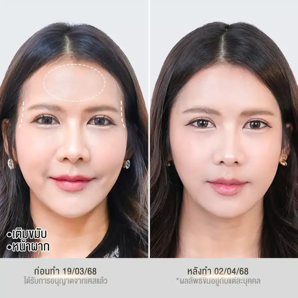 รีวิวฟิลเลอร์