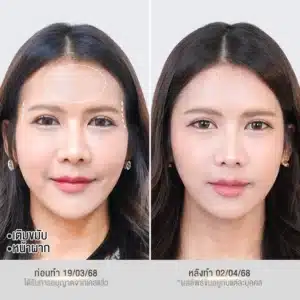 รีวิวฟิลเลอร์