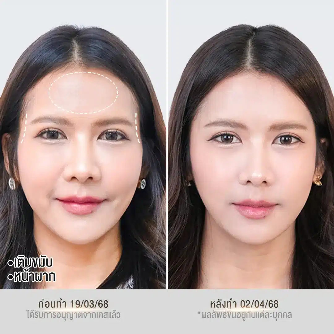 รีวิวฟิลเลอร์