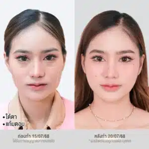 รีวิวฟิลเลอร์