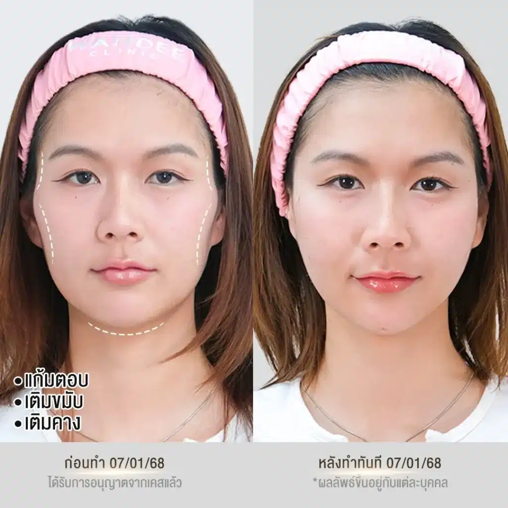 รีวิวฟิลเลอร์ จากวันดีคลินิก