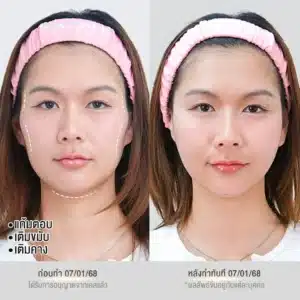 รีวิวฟิลเลอร์ จากวันดีคลินิก