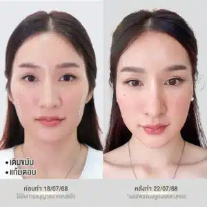 รีวิวฟิลเลอร์