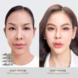 รีวิวฟิลเลอร์