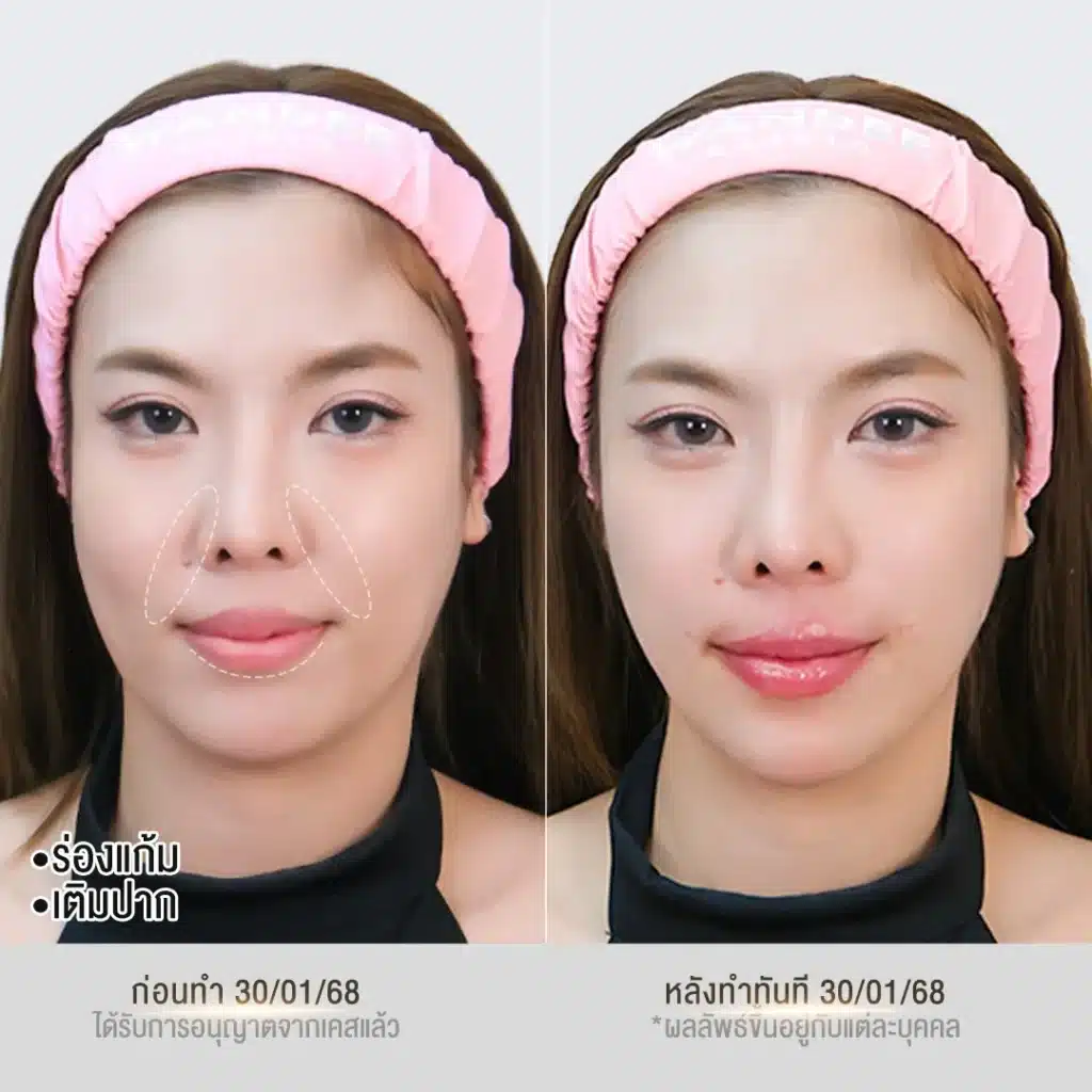 รีวิวฟิลเลอร์