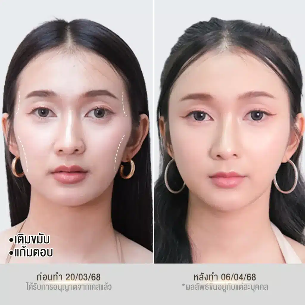 รีวิวฟิลเลอร์