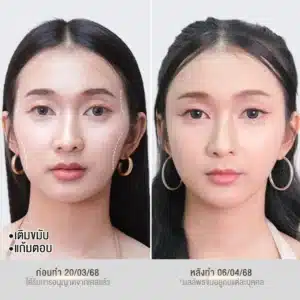 รีวิวฟิลเลอร์